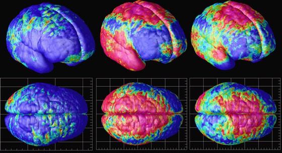 brain-imaging-study-heroin-addicts