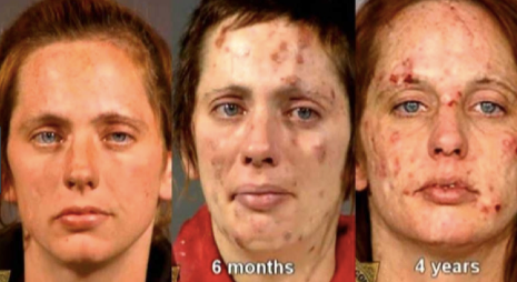 Faces Of Meth Before And After