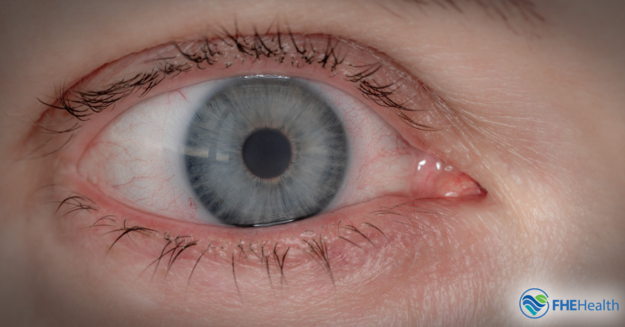 Bloodshot or dialated pupils - signs of drug abuse