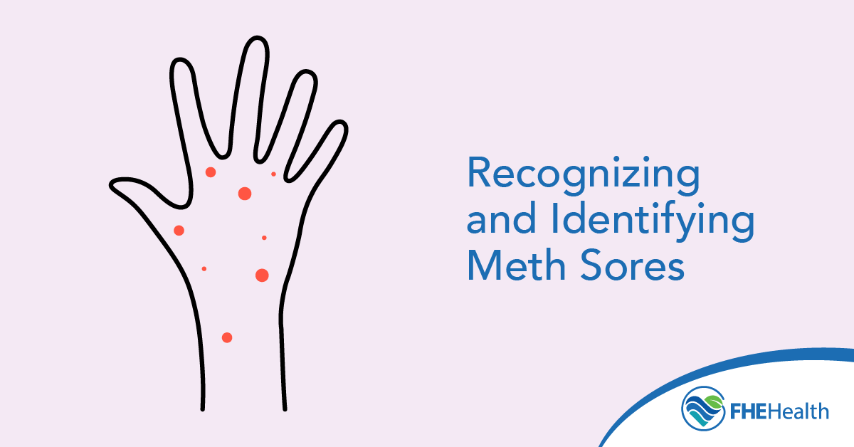 What are Meth Sores